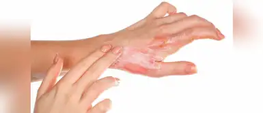 3 remedios caseros para tratar las quemaduras de aceite de cocina 3 remedios caseros para tratar las quemaduras de aceite de cocina