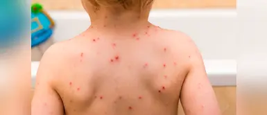 Varicela: 4 consejos que debes seguir si tu hijo tiene esta enfermedad Varicela: 4 consejos que debes seguir si tu hijo tiene esta enfermedad