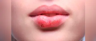 Herpes labial: 3 remedios caseros para aliviar la infección Herpes labial: 3 remedios caseros para aliviar la infección