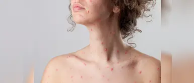 Varicela: mitos y verdades sobre esta enfermedad Varicela: mitos y verdades sobre esta enfermedad