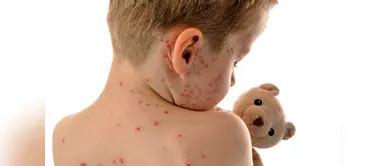 Varicela: 5 datos importantes que no conocías sobre esta enfermedad Varicela: 5 datos importantes que no conocías sobre esta enfermedad