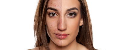 Dos productos que puedes utilizar para combatir los granitos y espinillas Dos productos que puedes utilizar para combatir los granitos y espinillas