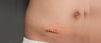 Apendicitis: qué es, síntomas y todo lo que necesitas saber de esta afección Apendicitis: qué es, síntomas y todo lo que necesitas saber de esta afección