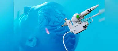 Epilepsia: cirugía permite a pacientes mejorar su calidad de vida Epilepsia: cirugía permite a pacientes mejorar su calidad de vida