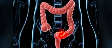 La detección es una medida importante en la prevención del cáncer del colon La detección es una medida importante en la prevención del cáncer del colon