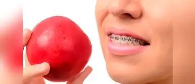 ¡7 Alimentos que debes evitar si usas brackets! ¡7 Alimentos que debes evitar si usas brackets!