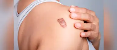 ¿Cicatrices bultosas? Remedios caseros para mejorar su apariencia ¿Cicatrices bultosas? Remedios caseros para mejorar su apariencia