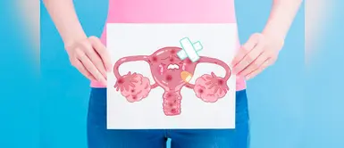 Cáncer de ovario: qué es, síntomas, tratamiento y todo sobre esta enfermedad Cáncer de ovario: qué es, síntomas, tratamiento y todo sobre esta enfermedad