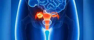Cáncer de ovario: 4 puntos clave para luchar contra esta enfermedad Cáncer de ovario: 4 puntos clave para luchar contra esta enfermedad