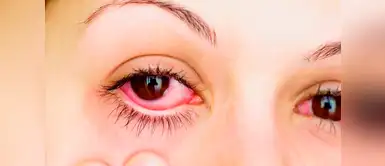 3 infusiones para tratar la conjuntivitis y aliviar los síntomas 3 infusiones para tratar la conjuntivitis y aliviar los síntomas