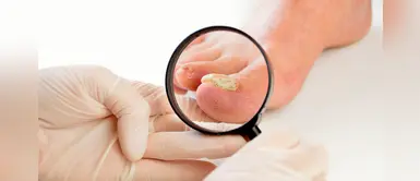 Hongos en las uñas de los pies: conoce los métodos para un tratamiento adecuado Hongos en las uñas de los pies: conoce los métodos para un tratamiento adecuado