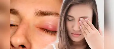 ¿Por qué nos salen orzuelos? Conoce la causa y cómo prevenirlos ¿Por qué nos salen orzuelos? Conoce la causa y cómo prevenirlos