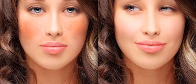 ¿Cómo prevenir la hiperpigmentación? Te contamos la solución ¿Cómo prevenir la hiperpigmentación? Te contamos la solución