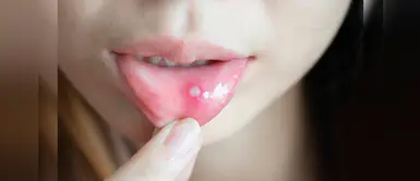 Afta bucal: remedios naturales para aliviar la molestia y curar las heridas Afta bucal: remedios naturales para aliviar la molestia y curar las heridas