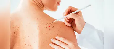 ¿Te salió un lunar rojo? Estas serían las posibles razones ¿Te salió un lunar rojo? Estas serían las posibles razones