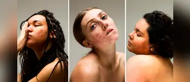 Fotógrafa crea campaña de belleza para normalizar rosácea, acné y dermatitis Fotógrafa crea campaña de belleza para normalizar rosácea, acné y dermatitis