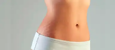 ¿Sabes qué produce las estrías? Ojo, el embarazo no es el único motivo ¿Sabes qué produce las estrías? Ojo, el embarazo no es el único motivo