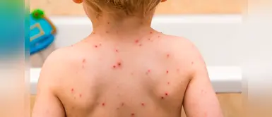 Varicela: ¿Quiénes son más propensos a padecer esta enfermedad? Varicela: ¿Quiénes son más propensos a padecer esta enfermedad?