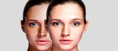 ¿Qué es el melasma y cómo solucionarlo? ¿Qué es el melasma y cómo solucionarlo?