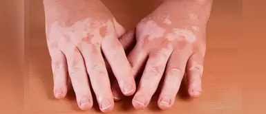 Científicos de Cuba anuncian la cura para el vitíligo Científicos de Cuba anuncian la cura para el vitíligo