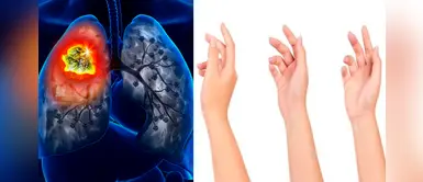 ¿Sabías que la posición de los dedos podría detectar el cáncer de pulmón? ¿Sabías que la posición de los dedos podría detectar el cáncer de pulmón?