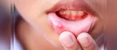 ¿Escorbuto, aftas o herpes? Conoce las diferencias ¿Escorbuto, aftas o herpes? Conoce las diferencias