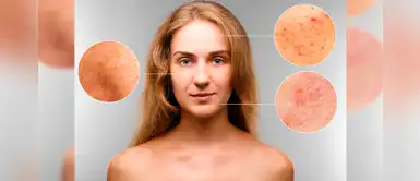 Hidroquinona: El más reciente tratamiento para una piel radiante, uniforme y sin manchas Hidroquinona: El más reciente tratamiento para una piel radiante, uniforme y sin manchas