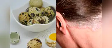 El huevo de codorniz, un poderoso alimento para combatir la psoriasis El huevo de codorniz, un poderoso alimento para combatir la psoriasis