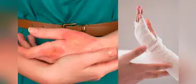 ¿Cuál es la diferencia entre las quemaduras de primer, segundo y tercer grado? ¿Cuál es la diferencia entre las quemaduras de primer, segundo y tercer grado?