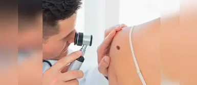 Cáncer a la piel: ¿Cómo saber si un lunar es peligroso? Cáncer a la piel: ¿Cómo saber si un lunar es peligroso?