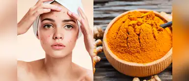 Prepara una mascarilla de cúrcuma y miel para eliminar las manchas del acné Prepara una mascarilla de cúrcuma y miel para eliminar las manchas del acné