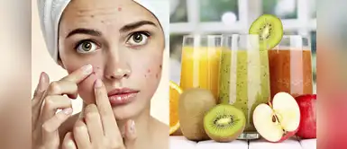 ¿Cómo combatir el acné? Prueba estos licuados poderosos y notarás la diferencia ¿Cómo combatir el acné? Prueba estos licuados poderosos y notarás la diferencia