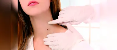 ¿Cómo reconocer los peligrosos síntomas de cáncer a la piel? ¿Cómo reconocer los peligrosos síntomas de cáncer a la piel?