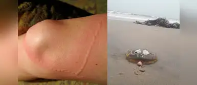 ¿Qué hacer si te pica una malagua? Sigue estos remedios caseros ¿Qué hacer si te pica una malagua? Sigue estos remedios caseros