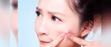 ¡No toques tu granos! Resiste a la tentación y elimínalos con hielo y aspirina ¡No toques tu granos! Resiste a la tentación y elimínalos con hielo y aspirina