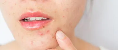 La técnica para ocultar el acné al 100% que se ha vuelto viral en Tik Tok La técnica para ocultar el acné al 100% que se ha vuelto viral en Tik Tok