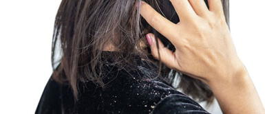 ¿Tienes problemas de caspa? Elimínala con vinagre y plátano ¿Tienes problemas de caspa? Elimínala con vinagre y plátano