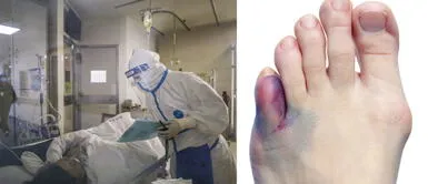 Coronavirus: Moretones y ampollas en los pies podrían ser los nuevos síntomas del COVID-19 Coronavirus: Moretones y ampollas en los pies podrían ser los nuevos síntomas del COVID-19