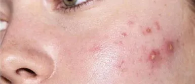 Prepara esta mascarilla que borra las manchas y marcas del acné Prepara esta mascarilla que borra las manchas y marcas del acné