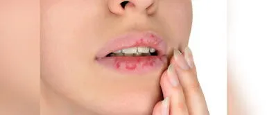 ¿Se te resecan los labios más a menudo? Conoce las causas y cómo prevenirlo ¿Se te resecan los labios más a menudo? Conoce las causas y cómo prevenirlo