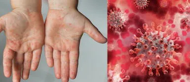 Kawasaki: ¿Qué es, qué relación tiene con la COVID-19 y cómo prevenir este mal en niños? Kawasaki: ¿Qué es, qué relación tiene con la COVID-19 y cómo prevenir este mal en niños?