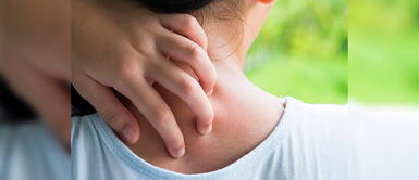 Dermatitis atópica en niños: "El 60% se manifiestan durante el primer año de vida", según dermatóloga Dermatitis atópica en niños: "El 60% se manifiestan durante el primer año de vida", según dermatóloga