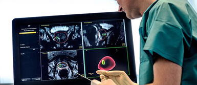 Cáncer de próstata: científicos encuentran un 'interruptor' que puede propagar este mal Cáncer de próstata: científicos encuentran un 'interruptor' que puede propagar este mal