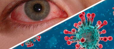 "Tener conjuntivitis no es sinónimo de coronavirus", explica oftalmólogo "Tener conjuntivitis no es sinónimo de coronavirus", explica oftalmólogo