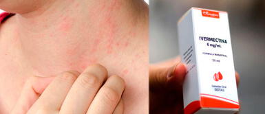 Dr. Elmer Huerta explica si una persona alérgica a los antibióticos puede tomar ivermectina Dr. Elmer Huerta explica si una persona alérgica a los antibióticos puede tomar ivermectina