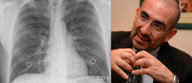 ¿Una ecografía pulmonar puede detectar el coronavirus? Dr. Elmer Huerta responde | VIDEO ¿Una ecografía pulmonar puede detectar el coronavirus? Dr. Elmer Huerta responde | VIDEO