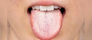 Doctor Jesús Ochoa explica cómo eliminar la placa blanca de la lengua Doctor Jesús Ochoa explica cómo eliminar la placa blanca de la lengua