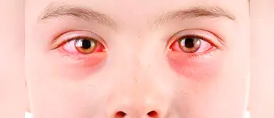 La conjuntivitis podría ser síntoma del síndrome semejante al kawasaki, según especialista La conjuntivitis podría ser síntoma del síndrome semejante al kawasaki, según especialista