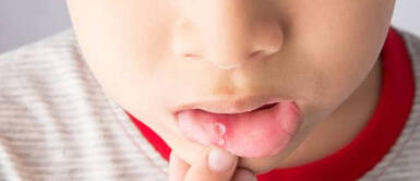 Aftas bucales en niños: ¿Cómo se manifiestan y formas de tratarla? Aftas bucales en niños: ¿Cómo se manifiestan y formas de tratarla?