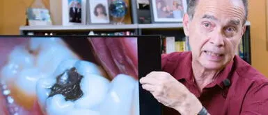 Amalgamas dentales pueden causar problemas de salud Amalgamas dentales pueden causar problemas de salud